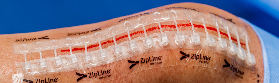 zipline skin closure device