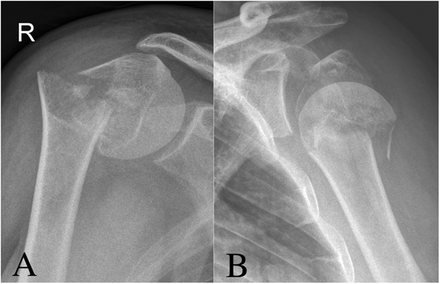 JBJS Webinar: Managing Complex Proximal Humeral Fractures - OrthoBuzz