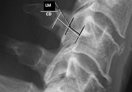 Novel Ratio Can Help Screen for Developmental Cervical Stenosis - OrthoBuzz