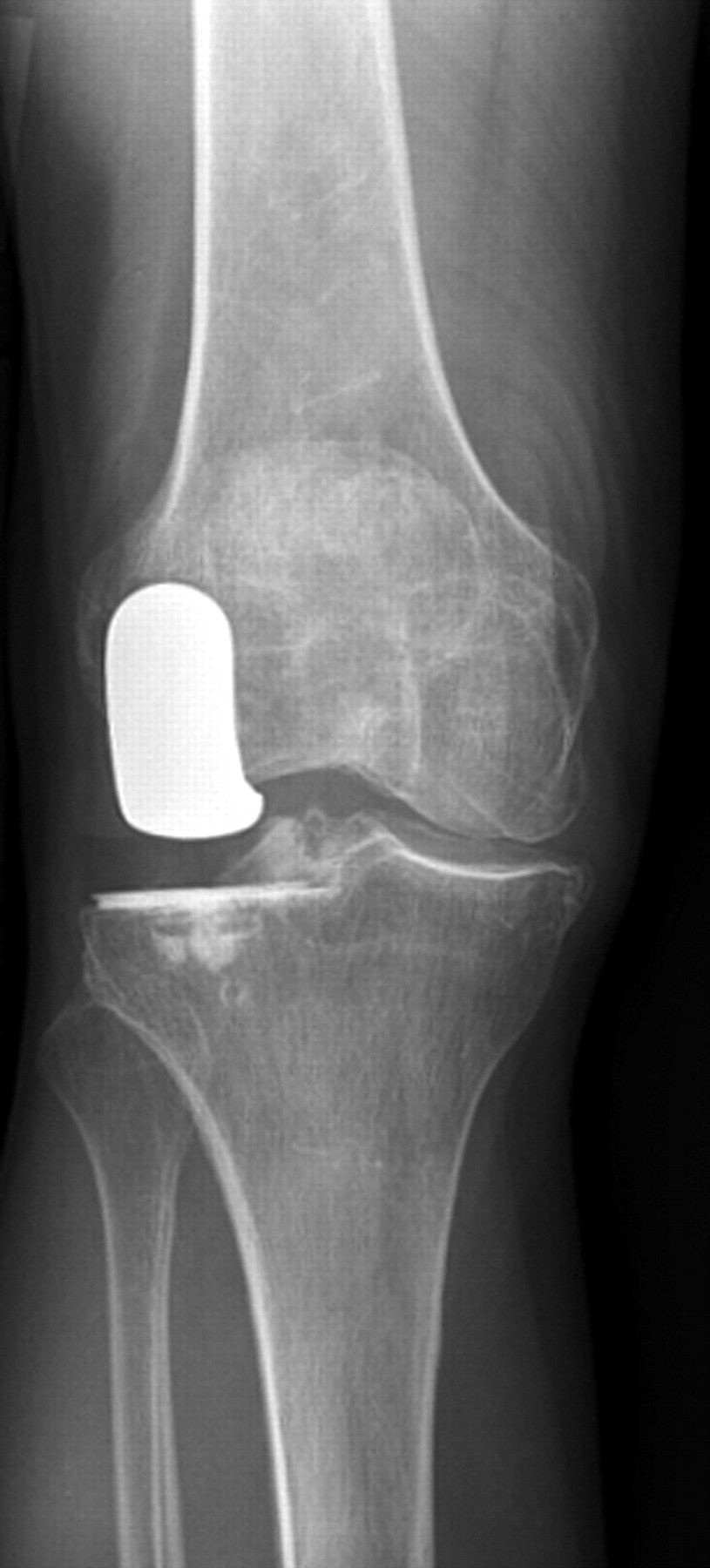 Cost Analysis of Treatments for Unicompartmental Knee Arthritis: UKA ...