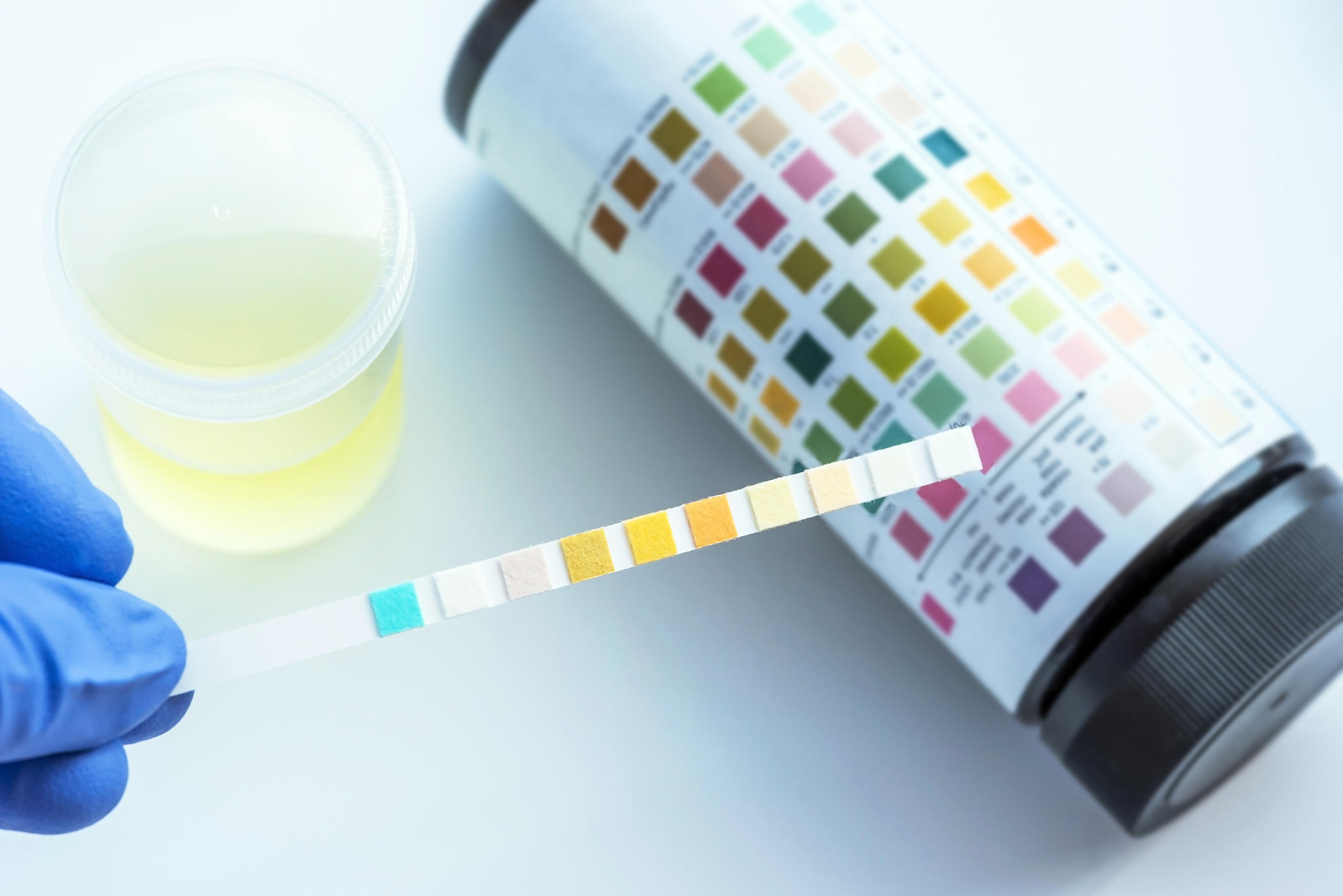 Diagnosing PJI When The “Urine Dipstick” Outperforms Conventional Labs