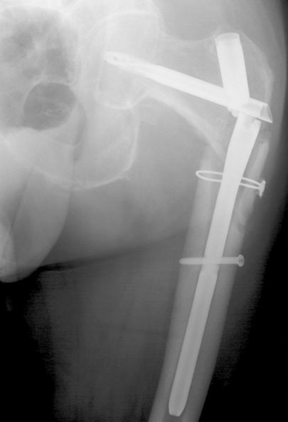 A Rash of Broken Femoral Nails—What's Up? - OrthoBuzz A Rash of Broken Femoral Nails—What's Up? - OrthoBuzz