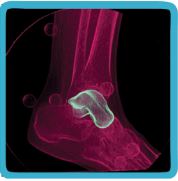 Subtalar Joint Compensation after Ankle Fusion - OrthoBuzz
