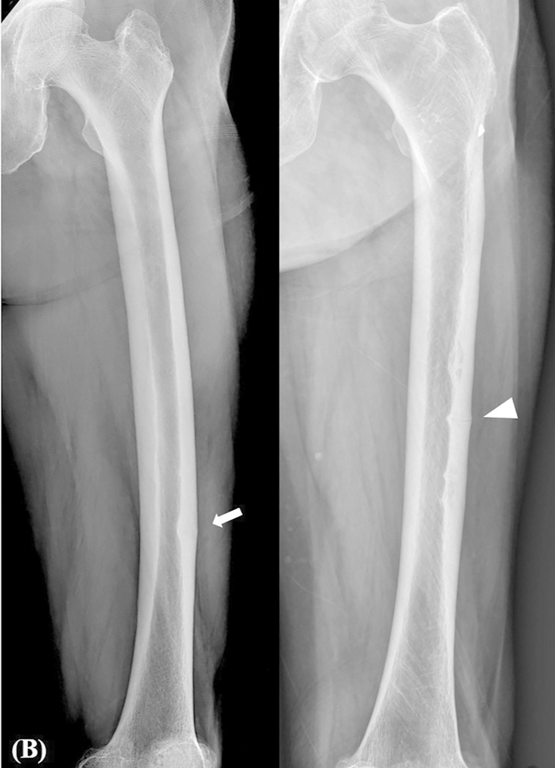Halt Bisphosphonates in Patients with an Atypical Femoral Fracture