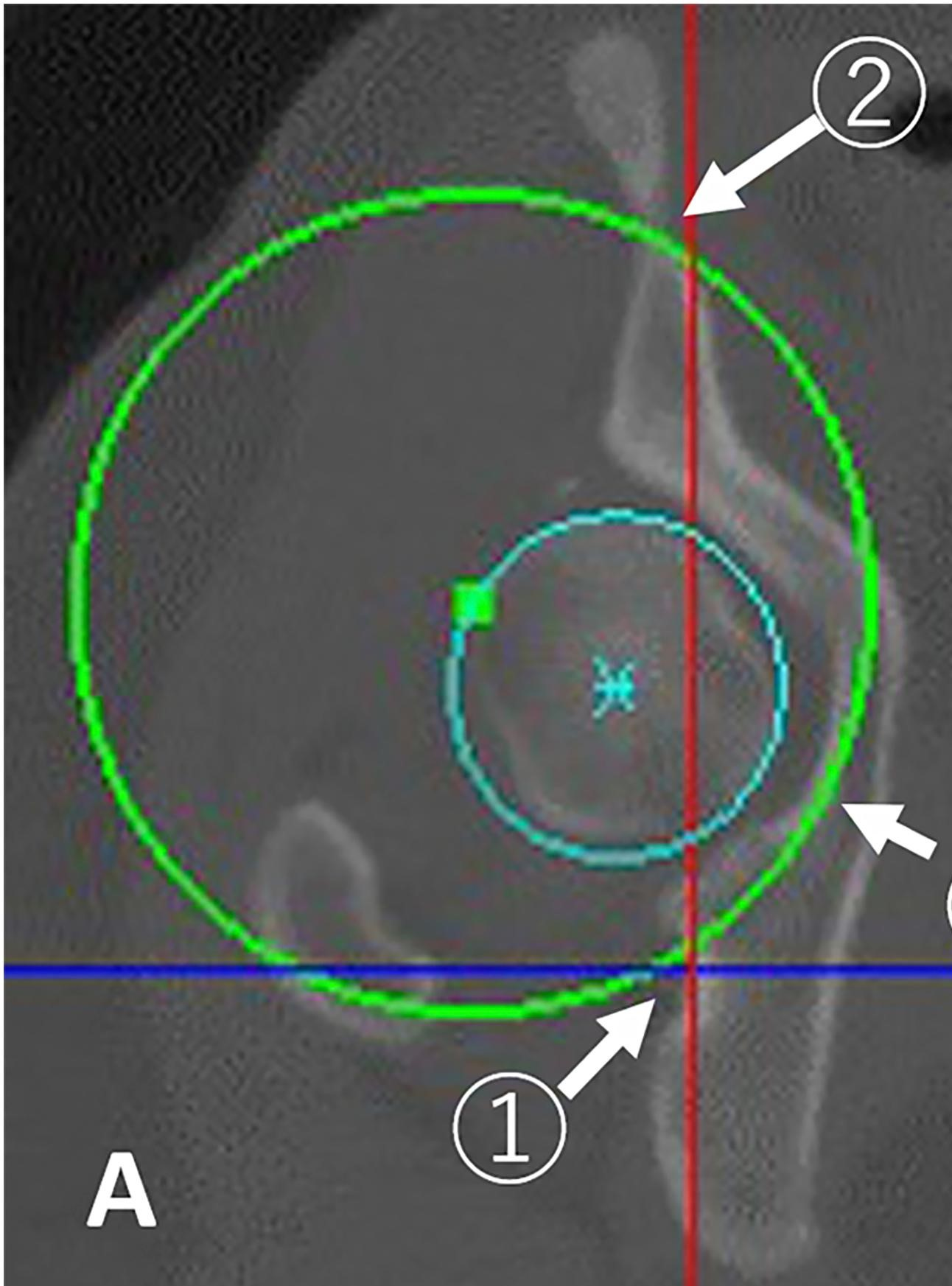 Periacetabular Osteotomy