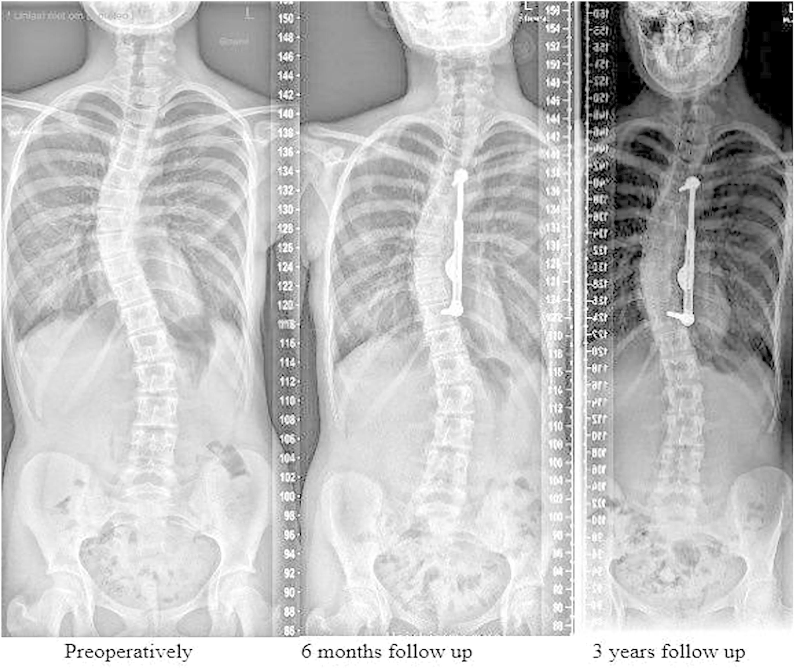 Growth in Scoliosis