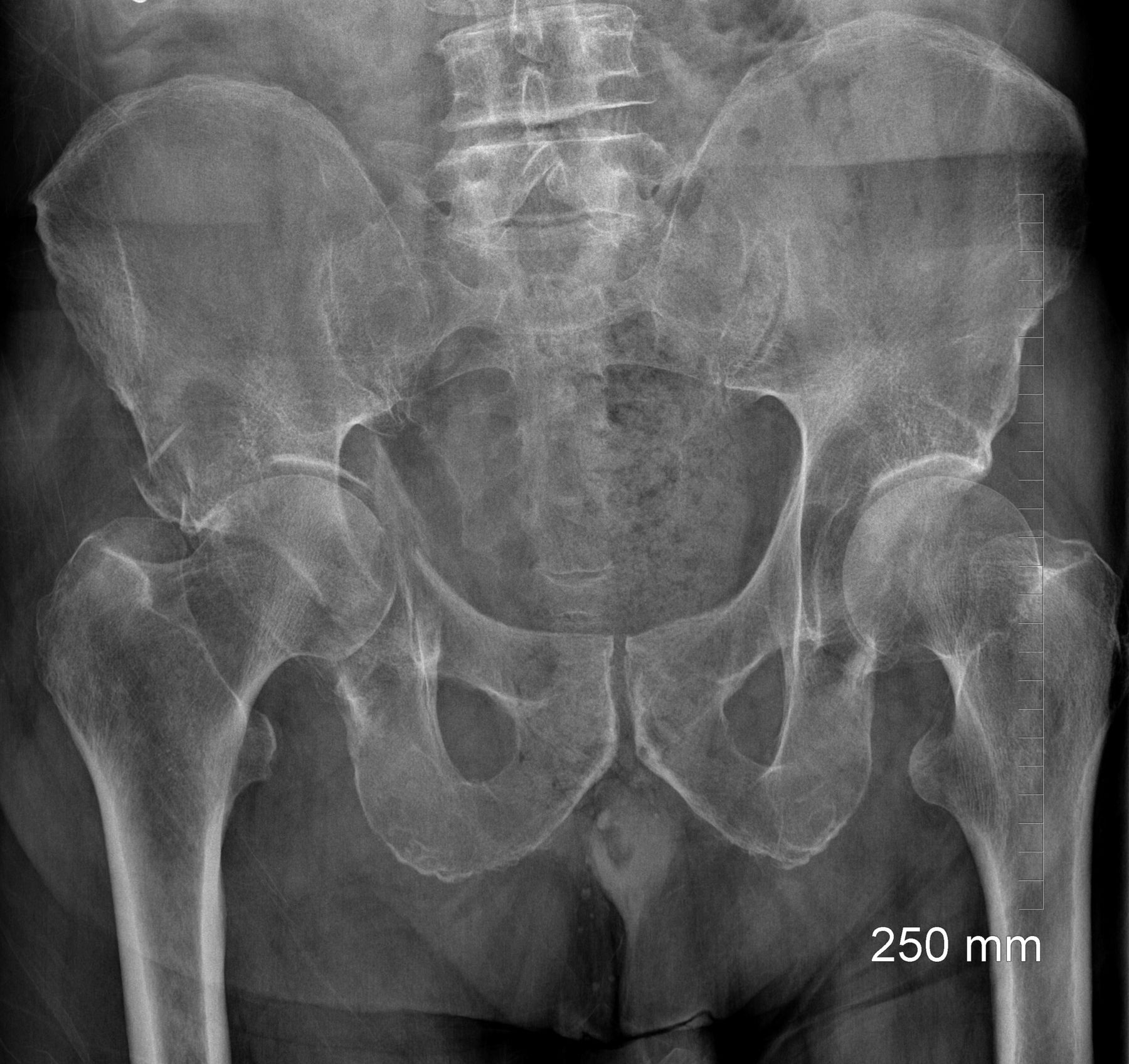 Hip Fractures Elderly