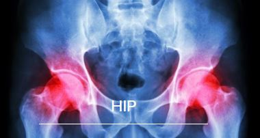 Hip Replacement