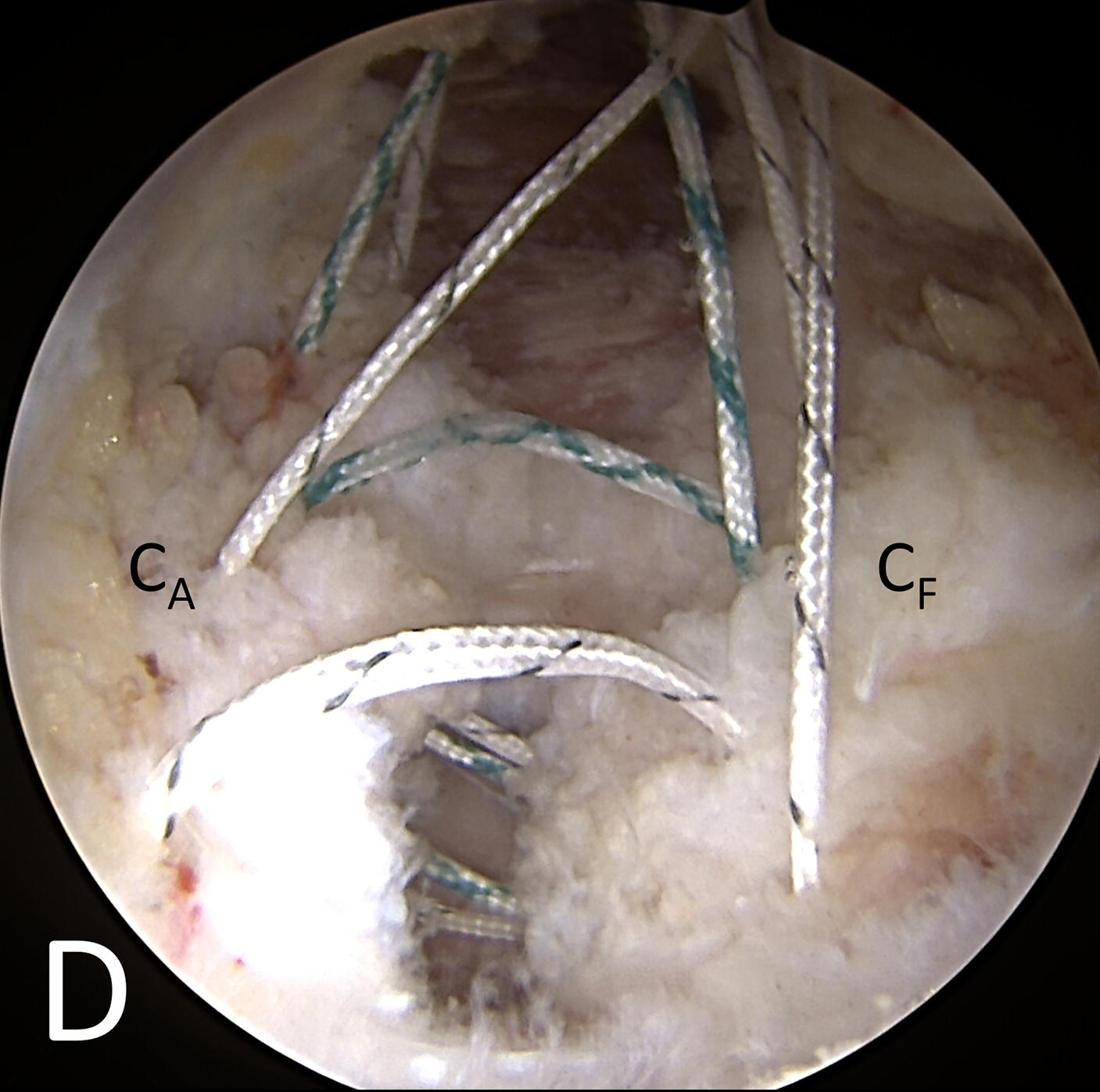 Hip Arthroscopy Capsule