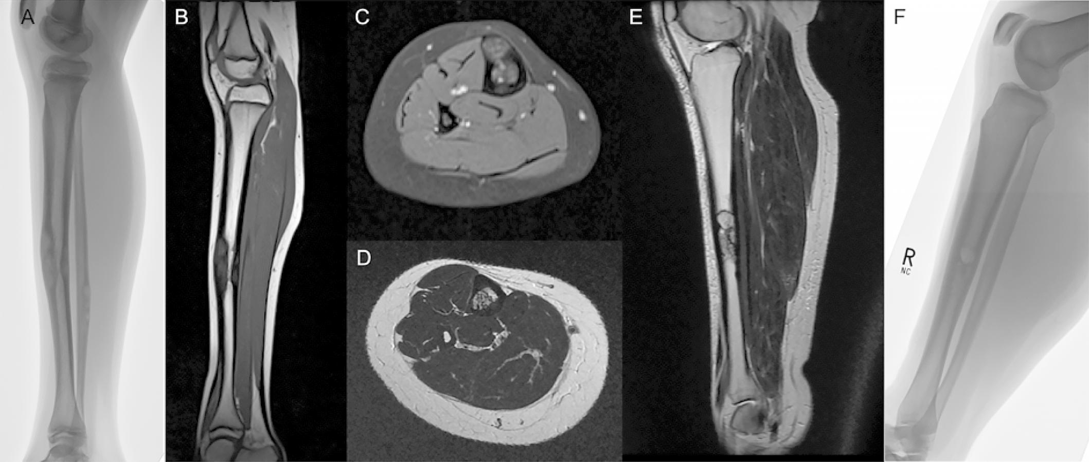 Whats New In Musculoskeletal Tumor Surgery 2021 Orthobuzz