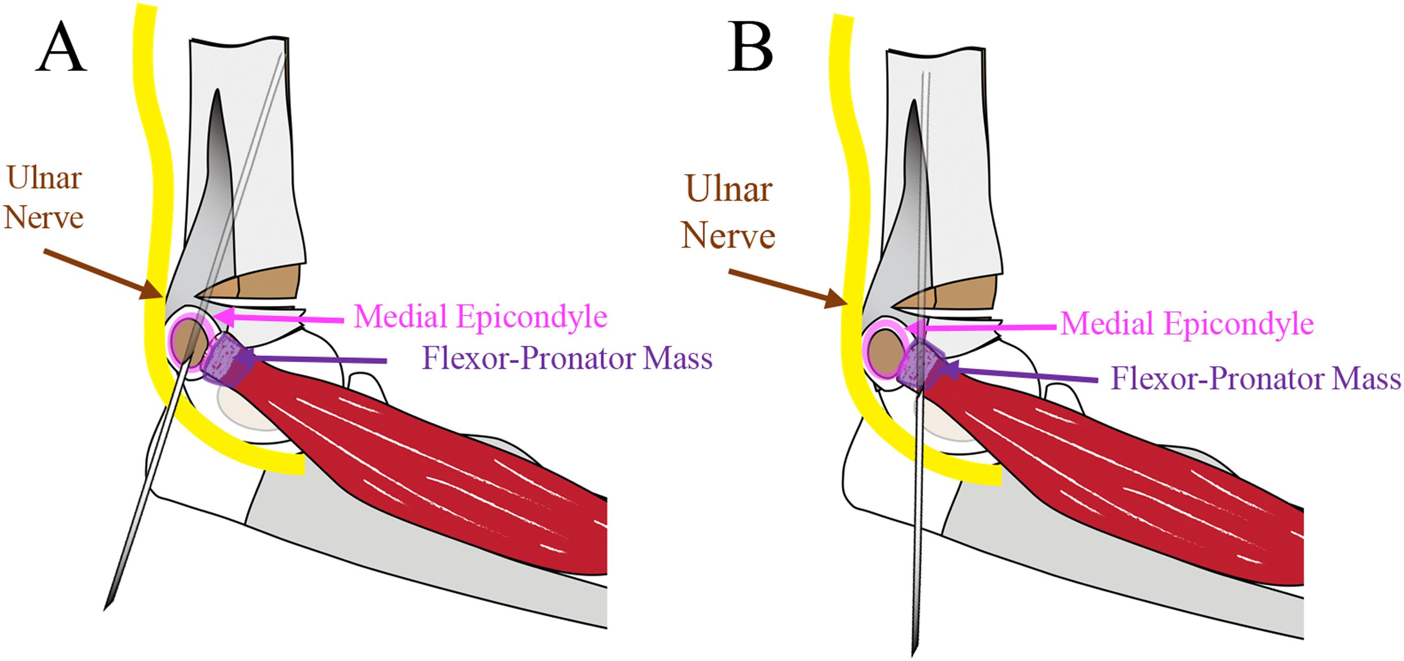 ulnar nerve palsy