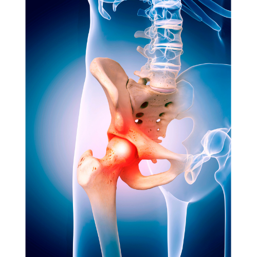 Hemiarthroplasty Femoral Neck Fractures