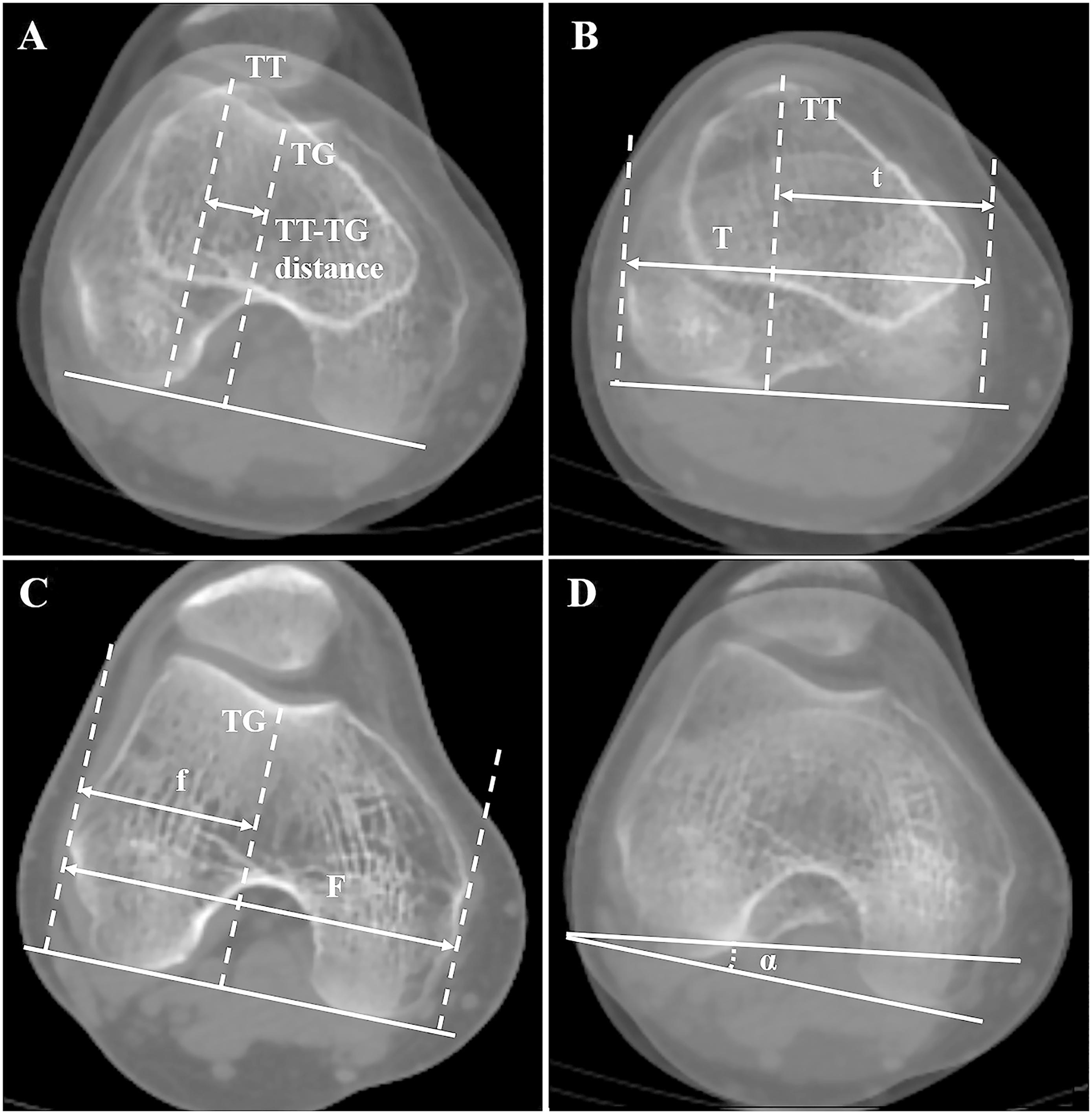 Tibial Tubercle-Trochlear Groove Distance