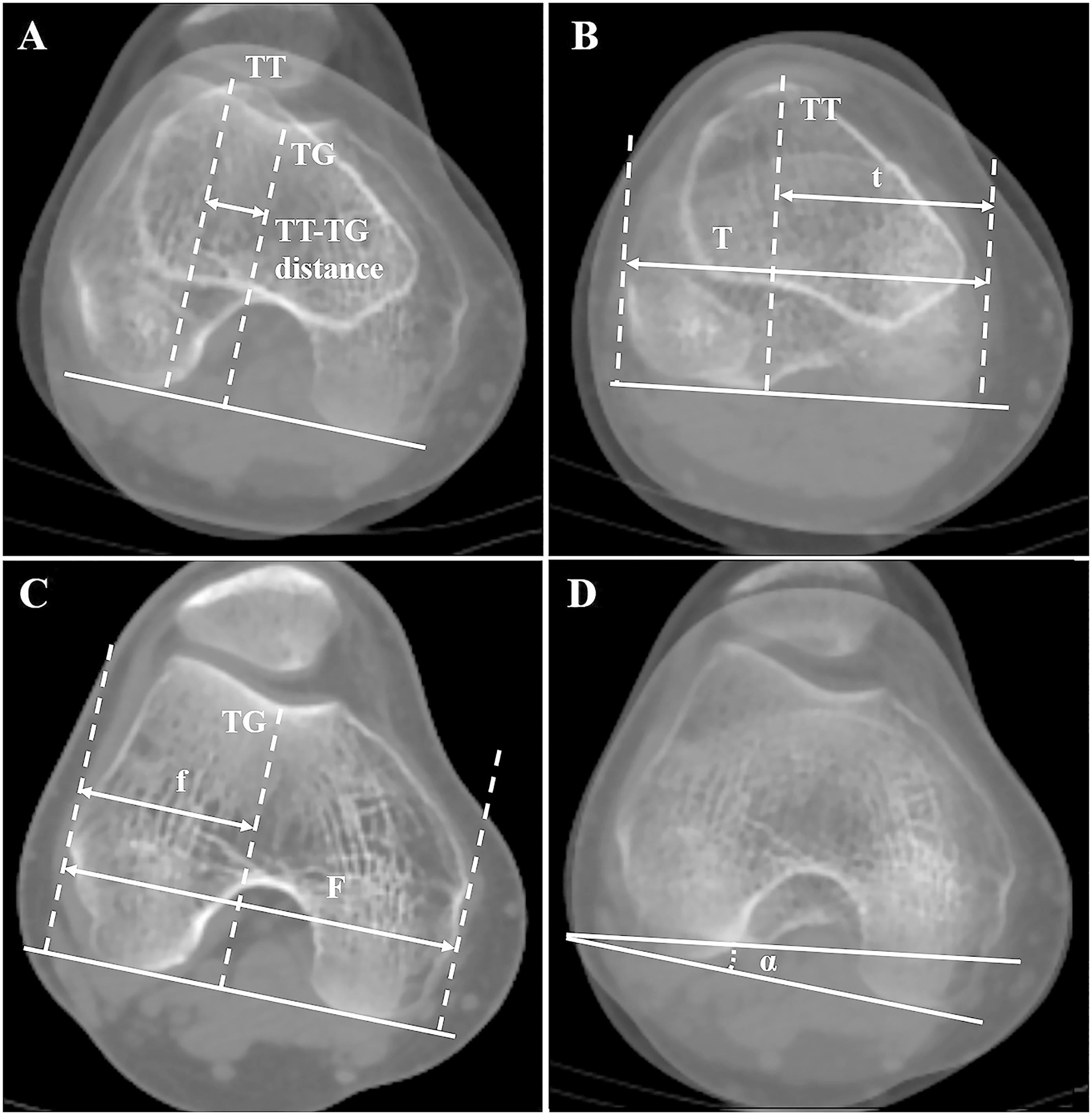 What Drives Increased Tibial TubercleTrochlear Groove Distance