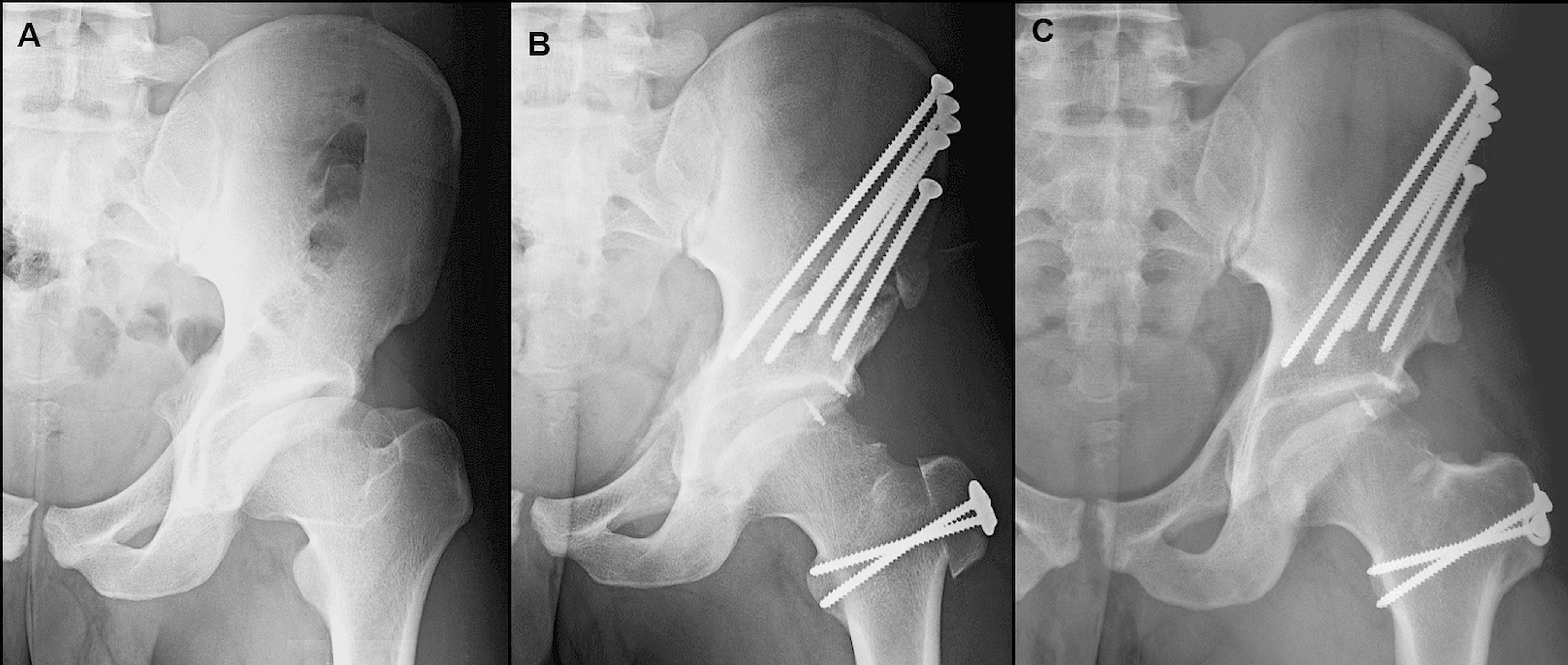 Radiographs of a 25-year-old woman with an LCP hip deformity who underwent combined SD and PAO