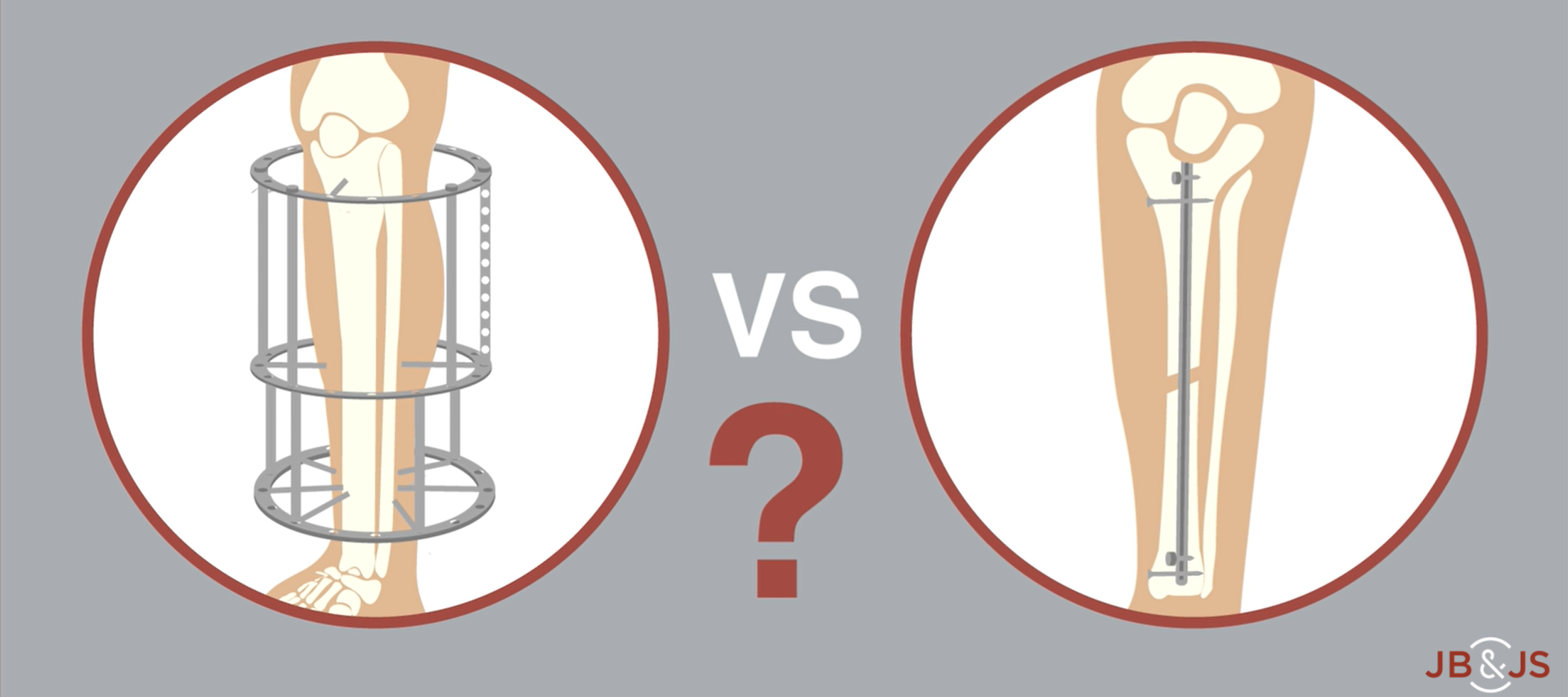 Modern External Ring Fixation versus Internal Fixation illustration