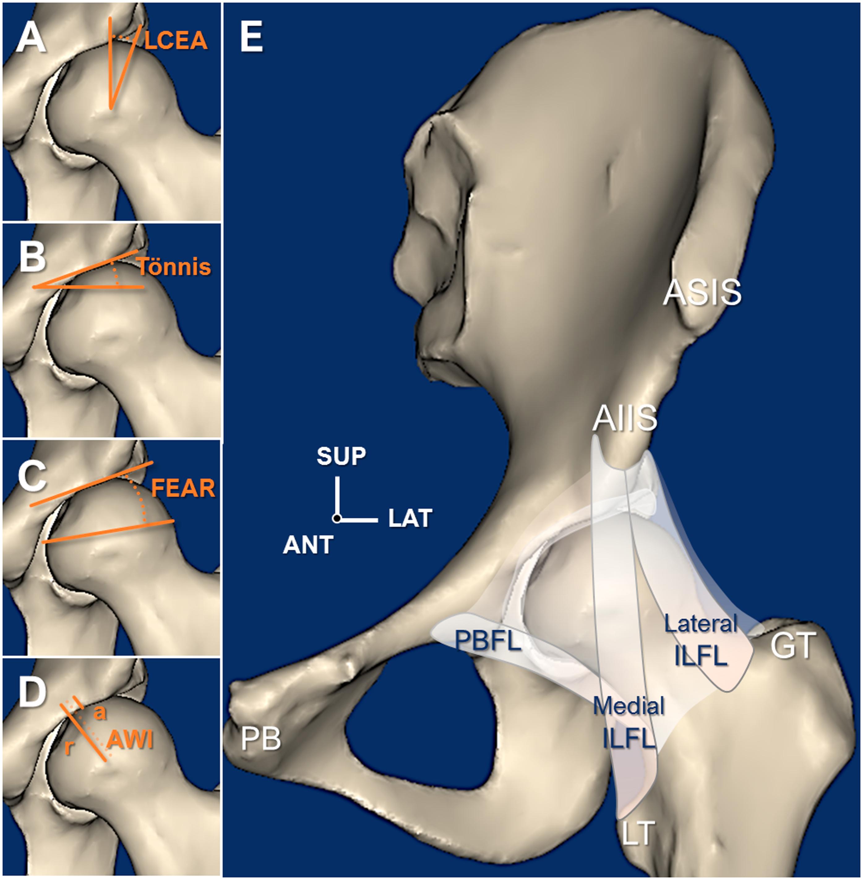 Render of Hip Dysplasia