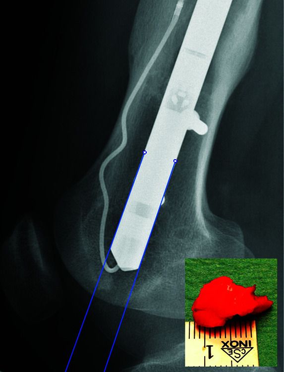 Sagittal radiograph of a distal femur and photograph of intra-articular lesion.