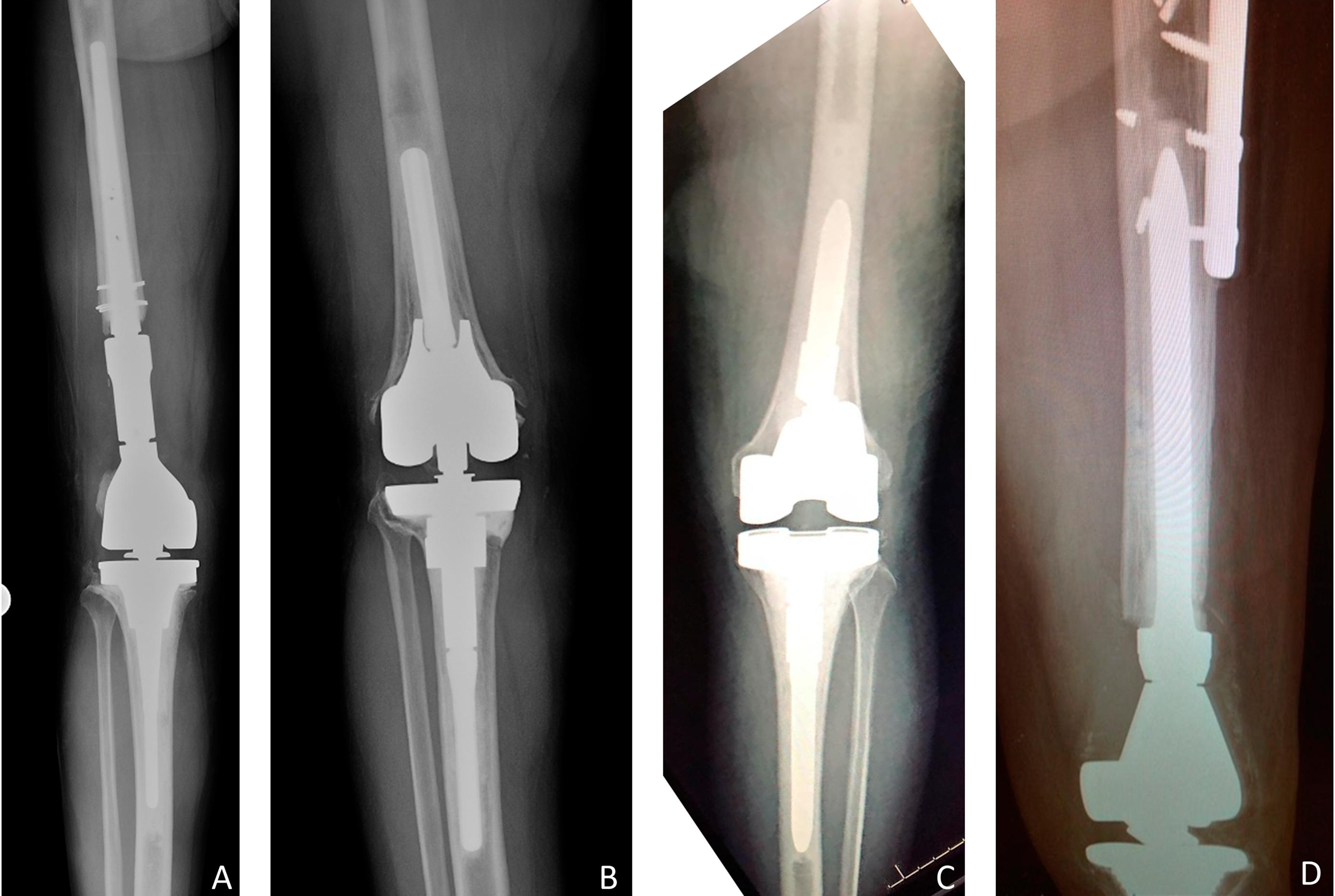 Radiograph of TKA with extensive instrumentation