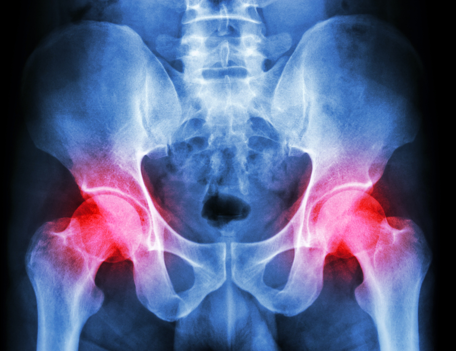 Total Hip Arthroplasty Patients Under 65 Have Low Revision Rates