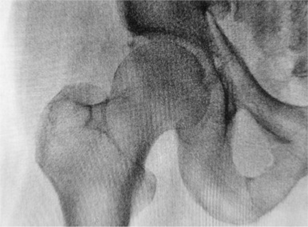 Hip radiograph of a patient with osteoporosis.