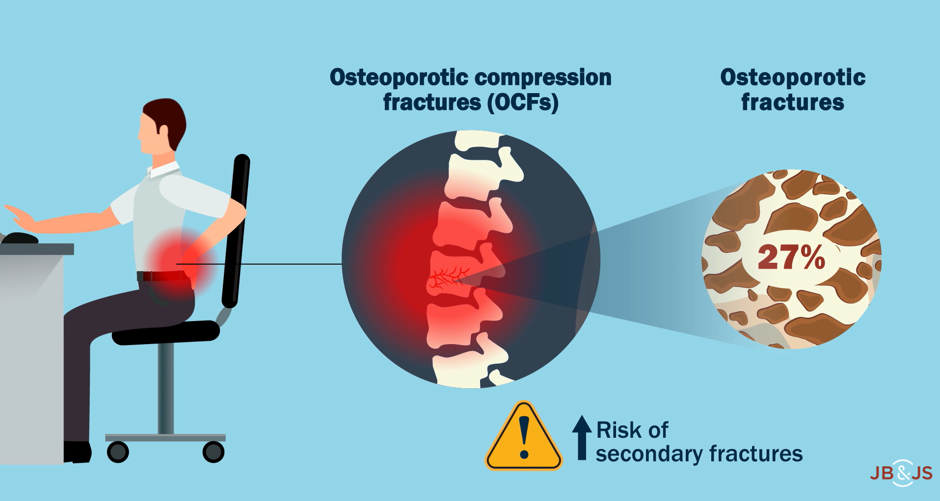 Illustrated graphic from video summary representing a compression fracture and back pain.