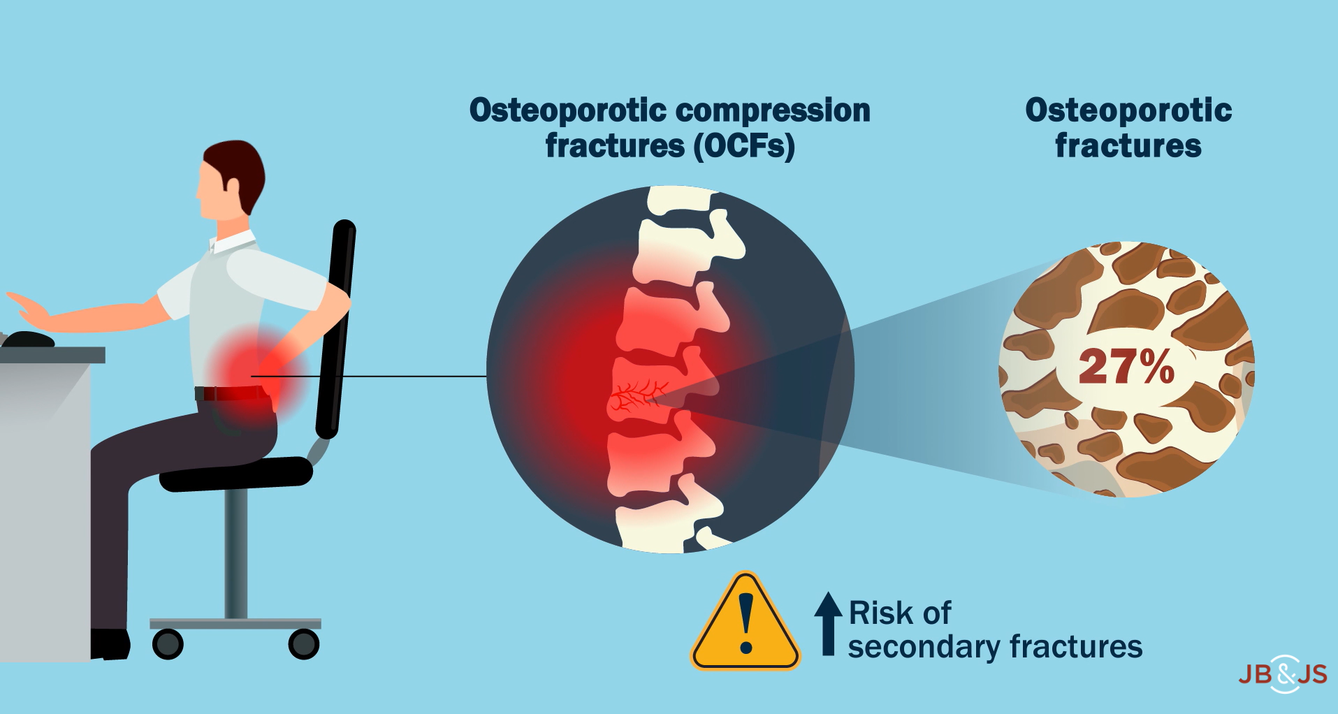 new-study-assesses-risk-of-secondary-osteoporotic-compression-fractures