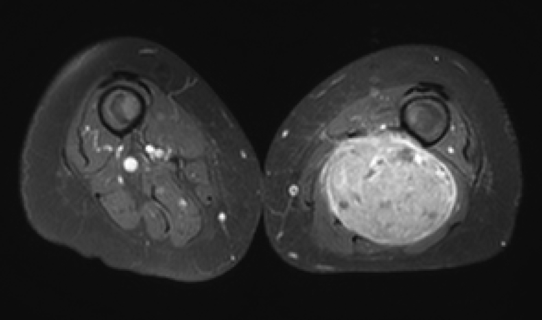 Radiograph of soft tissue sarcoma.