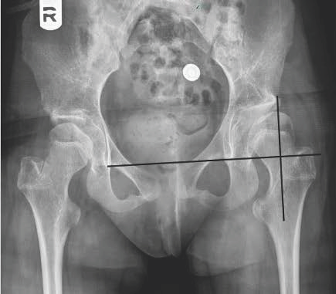 A patient with spastic quadriplegic cerebral palsy (GMFCS V) and progressive hip displacement after triradiate cartilage closure.