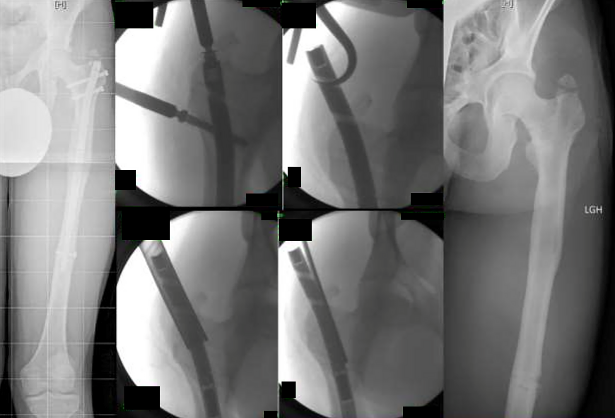 Intraoperative radiographs and fluoroscopic images showing breakage of the extraction mechanism assembly during the removal phase.