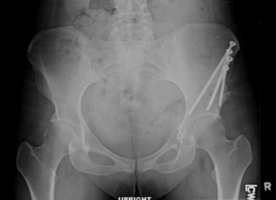 Immediate postoperative radiographs of a 34-year-old woman with a clinical diagnosis of symptomatic instability in the setting of borderline acetabular dysplasia and a 15-mm anterolateral labral tear in the left hip.