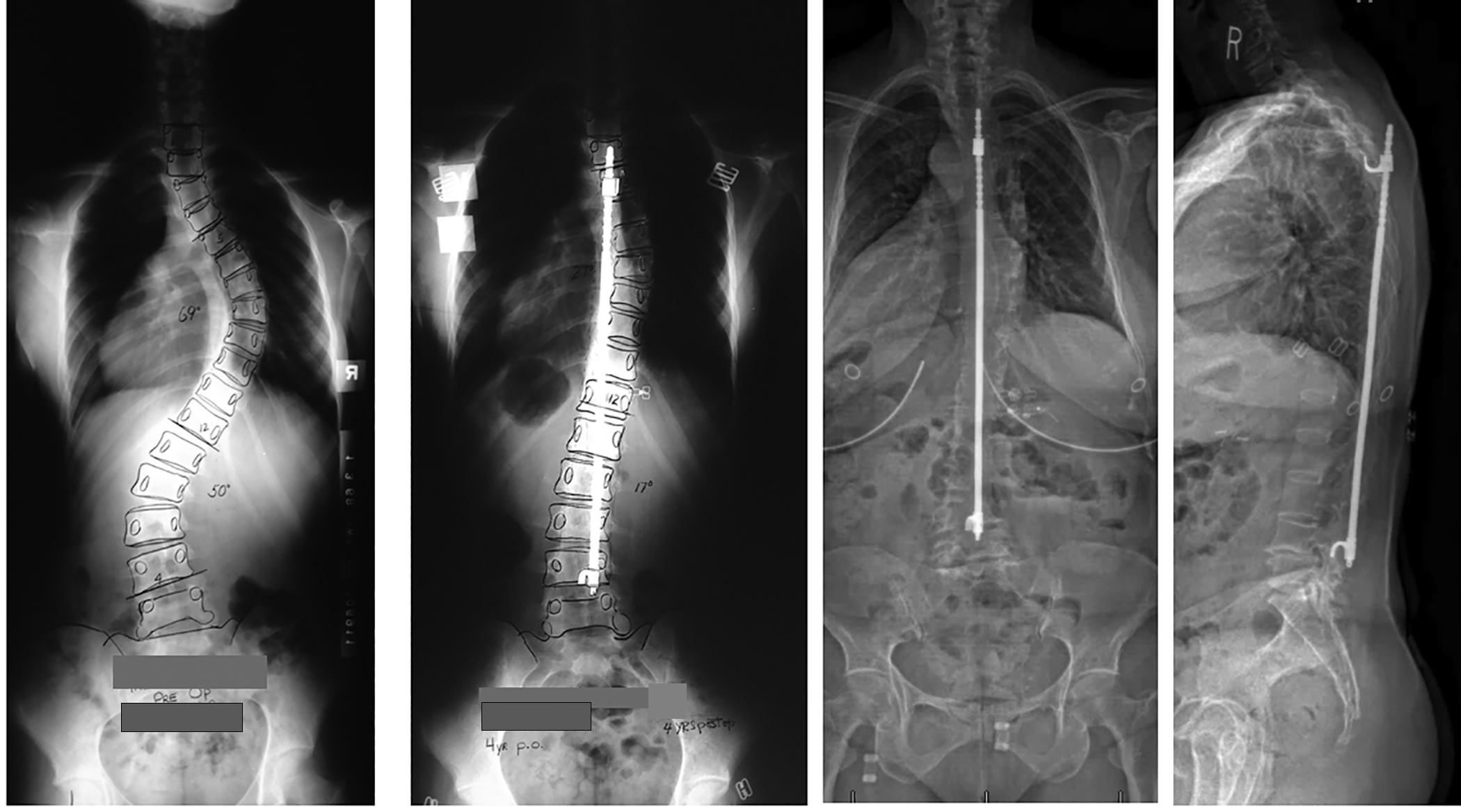 A series of radiographs of a patient with instrumentation and fusion from T4 to L4.