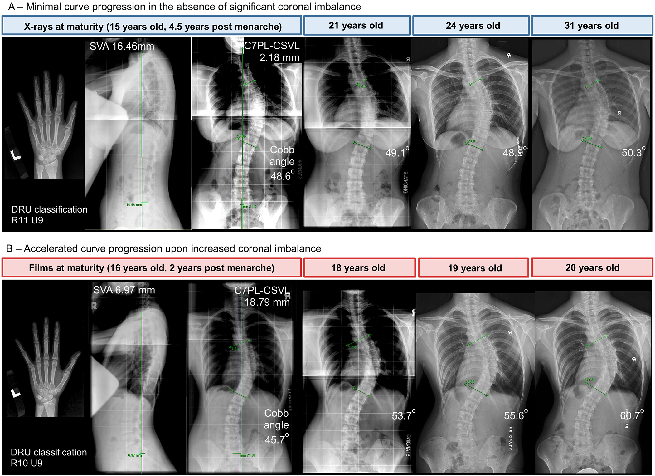 Examples of no progression and fast progression in adolescent idiopathic scoliosis curves of 40° to 50°.