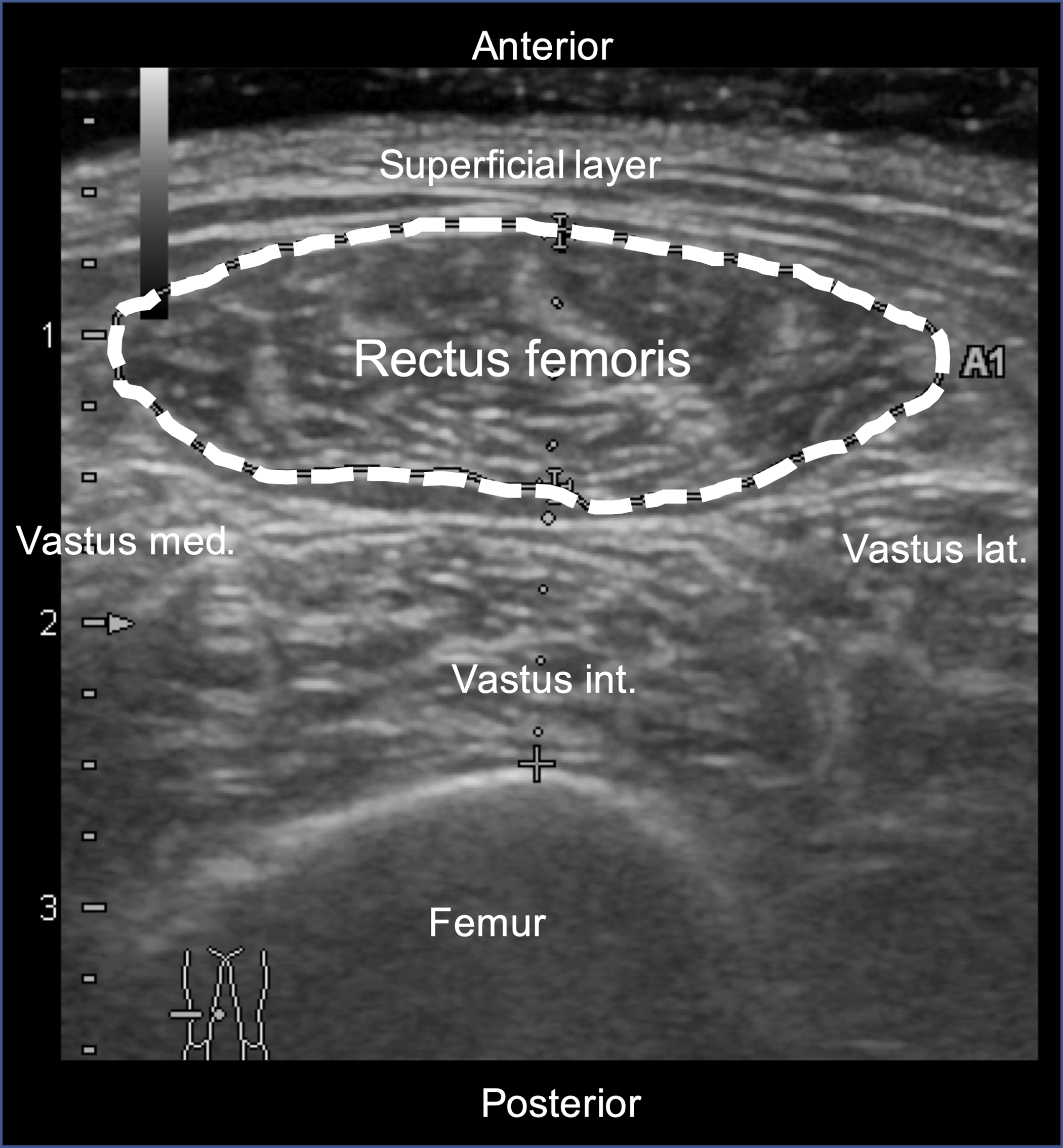 Ultrasonographic measurements of the rectus femoris muscle area.