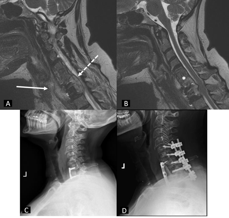 Preoperative T2 sagittal magnetic resonance imaging (Figs. 1-A and 1-B) demonstrating C6-T3 osteomyelitis (white asterisk), prevertebral abscess measuring 24 × 13 mm (solid white arrow), and an enhancing ventral epidural fluid collection spanning from C6 to T2 measuring 31 × 6 mm with cord compression (dashed white arrow). Preoperative (Fig. 1-C) and postoperative (Fig. 1-D) lateral radiograph after removal of spinal instrumentation, irrigation and debridement of the abscesses, partial C6 and T2 and complete C7 and T1 corpectomies, and combined anterior and posterior fusion of C6-T2 using iliac bone autograft and fibular allograft.