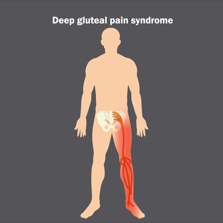 Anatomic illustration depicting deep gluteal pain syndrome.