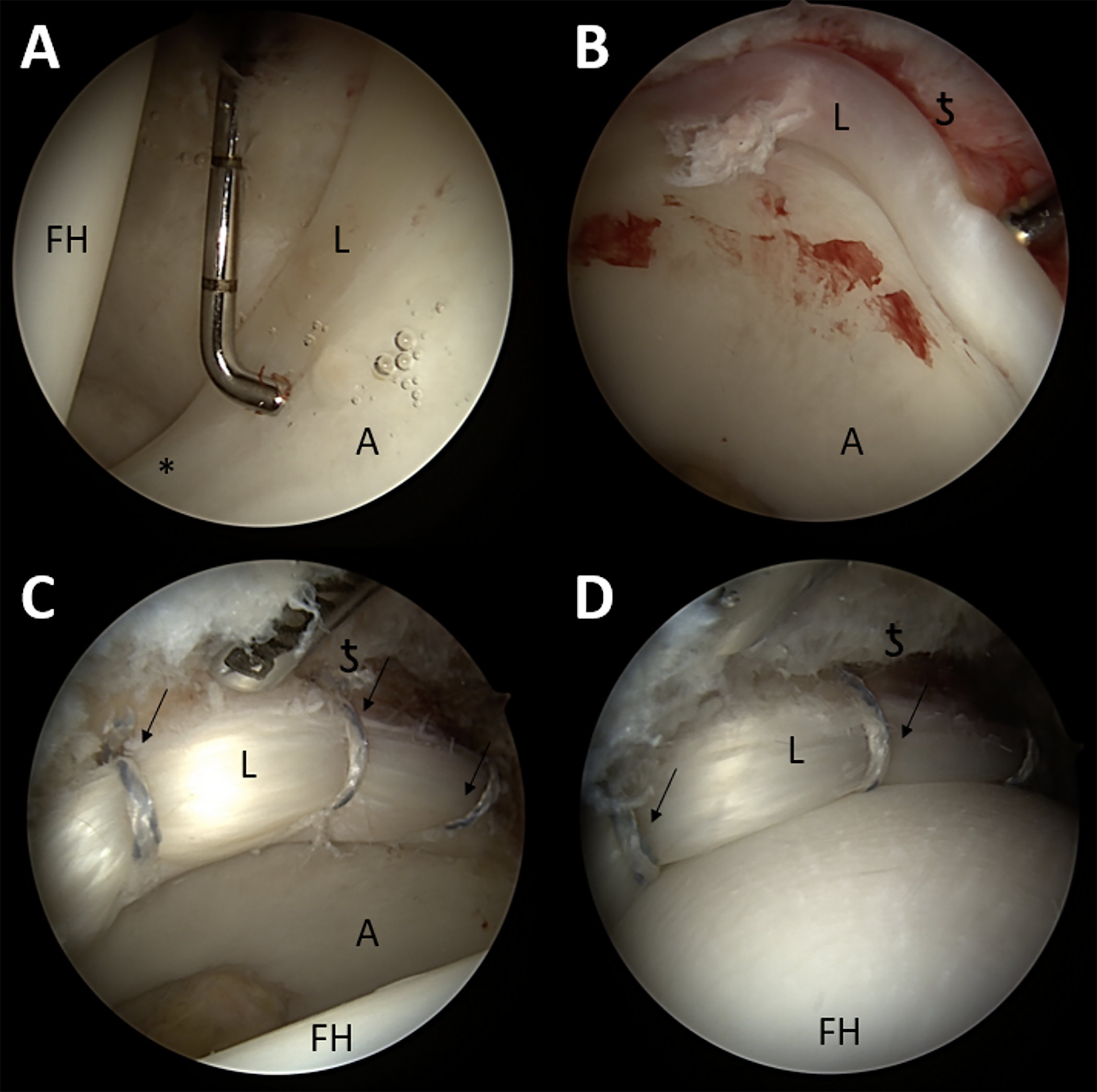 Intraoperative images of labral repair in a left hip with the patient in the supine position. The anterolateral portal was used as a visualization portal for the 70° arthroscope.