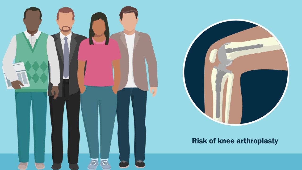A group of four individuals stand next to an illustration depicting risk of knee arthroplasty.