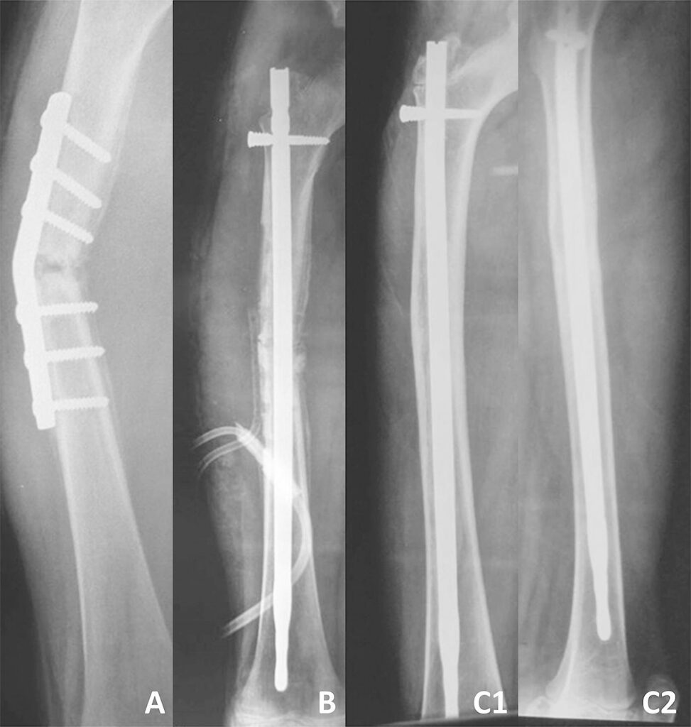 femoral nonunion