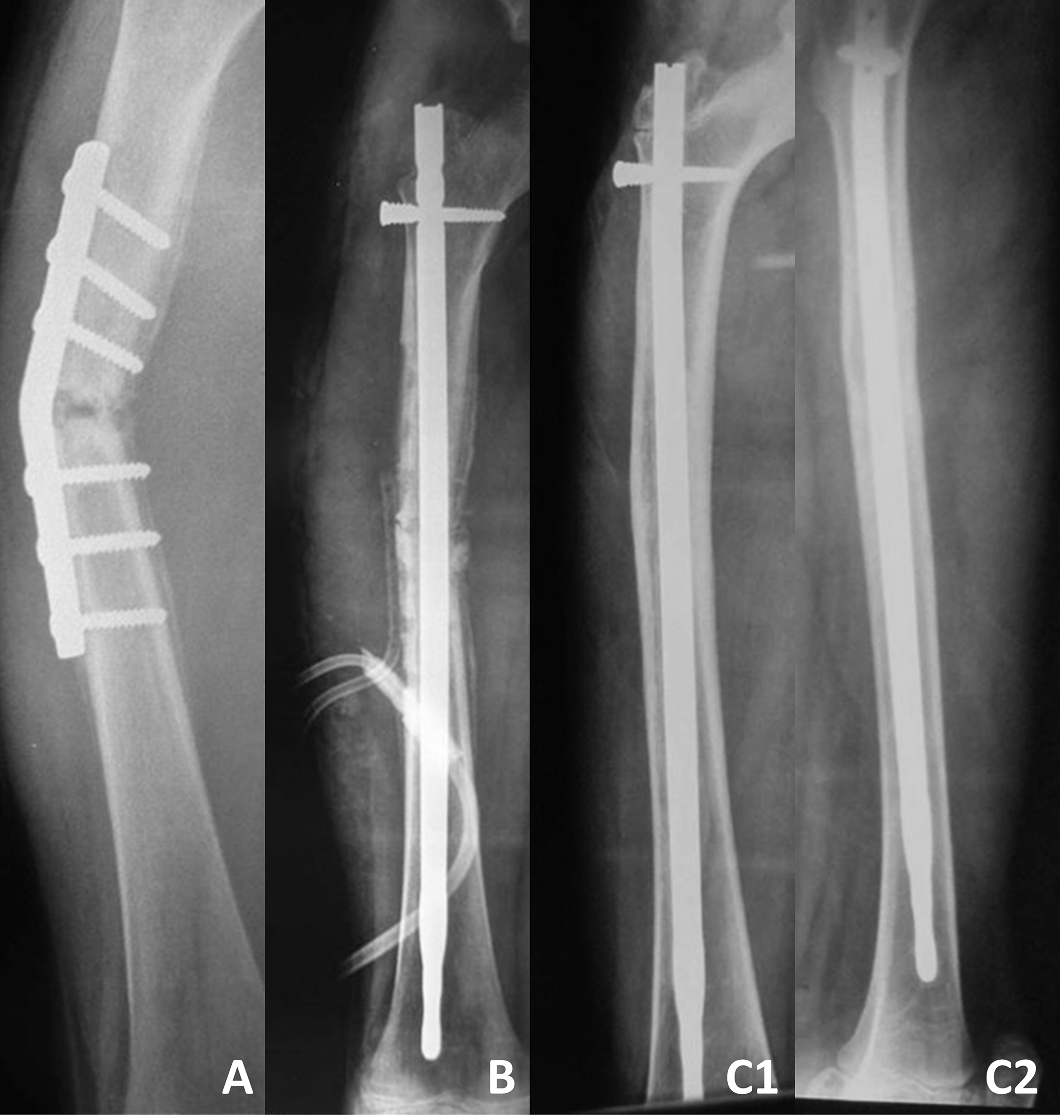 Radiographs of a typical SIGN database case file. The patient was a 12-year-old Afghan boy who had a midshaft femoral nonunion 4 months after failed ORIF.