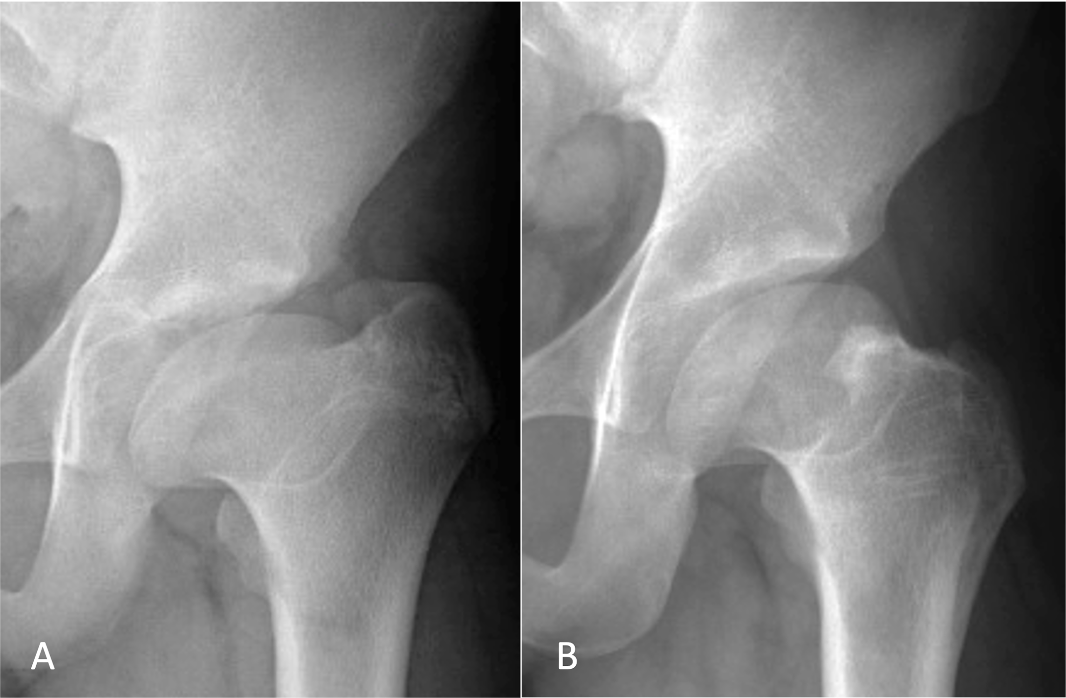 Preoperative and postoperative anteroposterior radiographs of the left hip of a 14-year-old male patient who was diagnosed with Legg-Calvé-Perthes disease at 10 years of age.