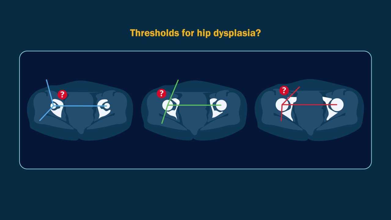 Illustration depicting three examples of acetabular sector angles in hip dysplasia.