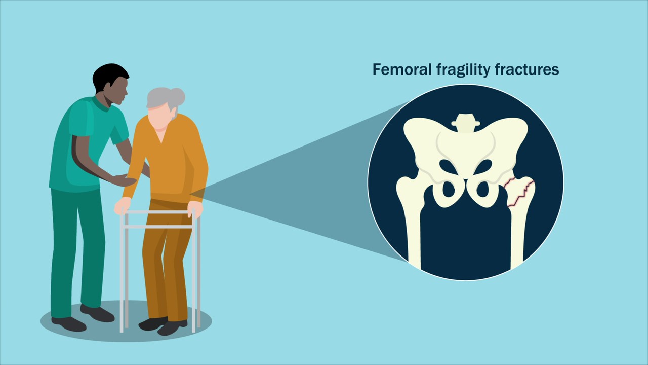 Femoral fragility fracture