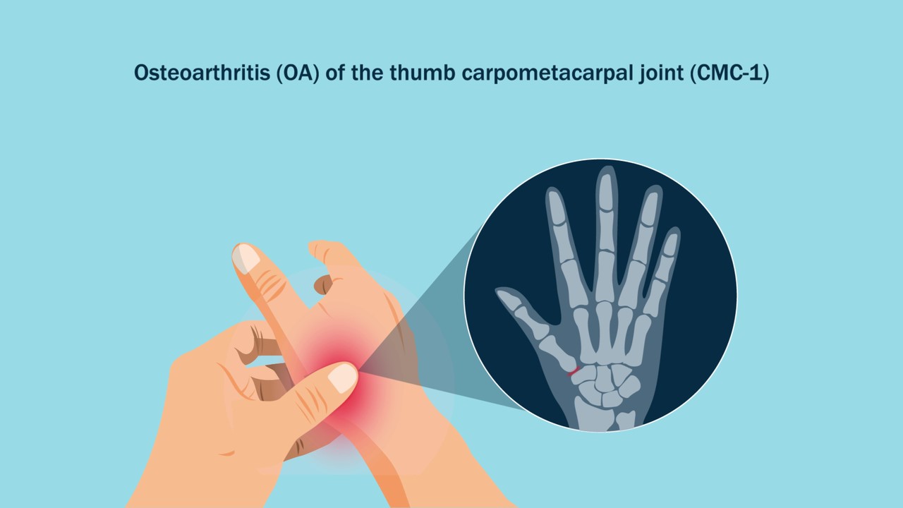 Illustration depicting thumb arthritis.