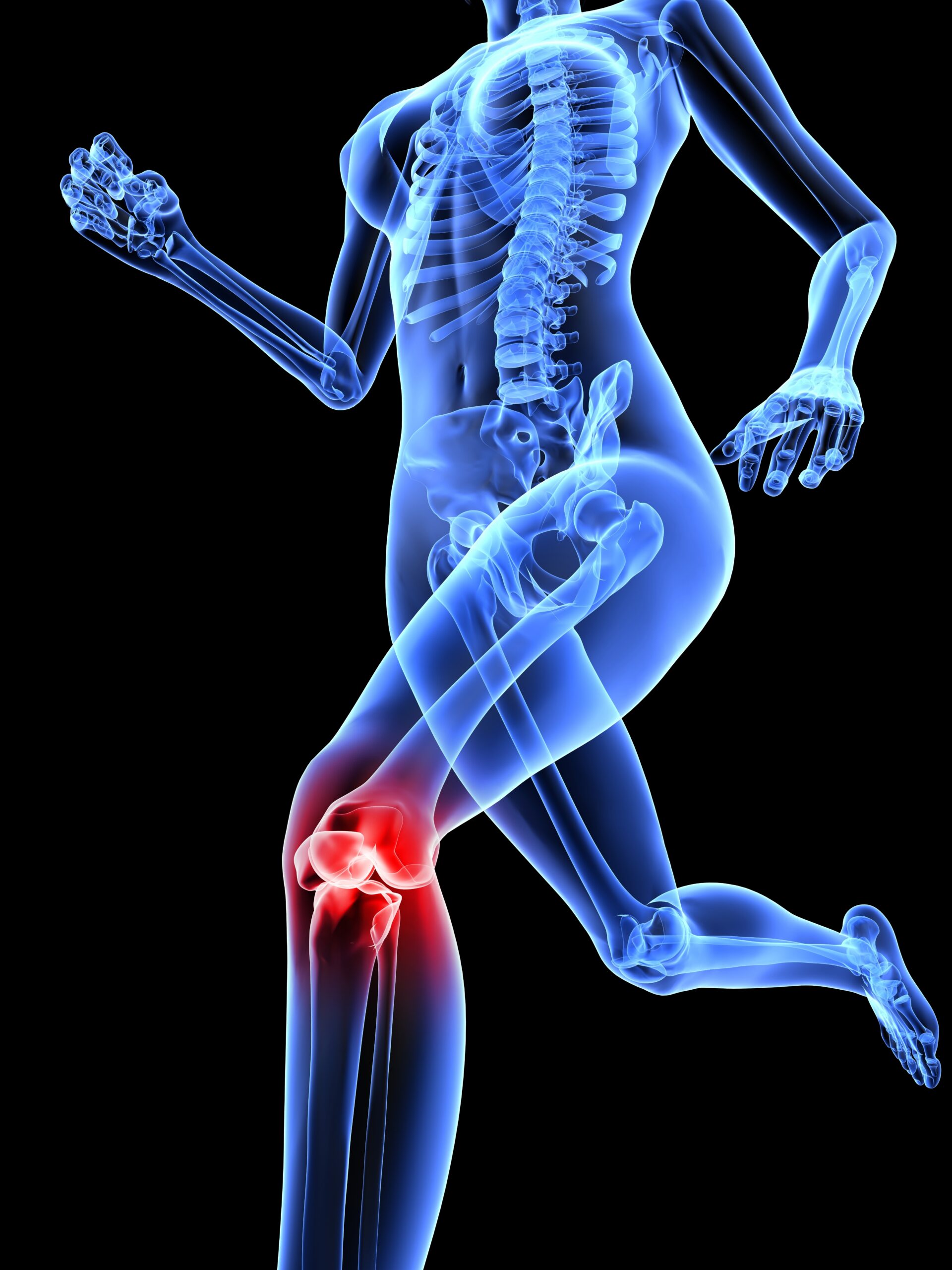 X-ray graphic representing knee pain.