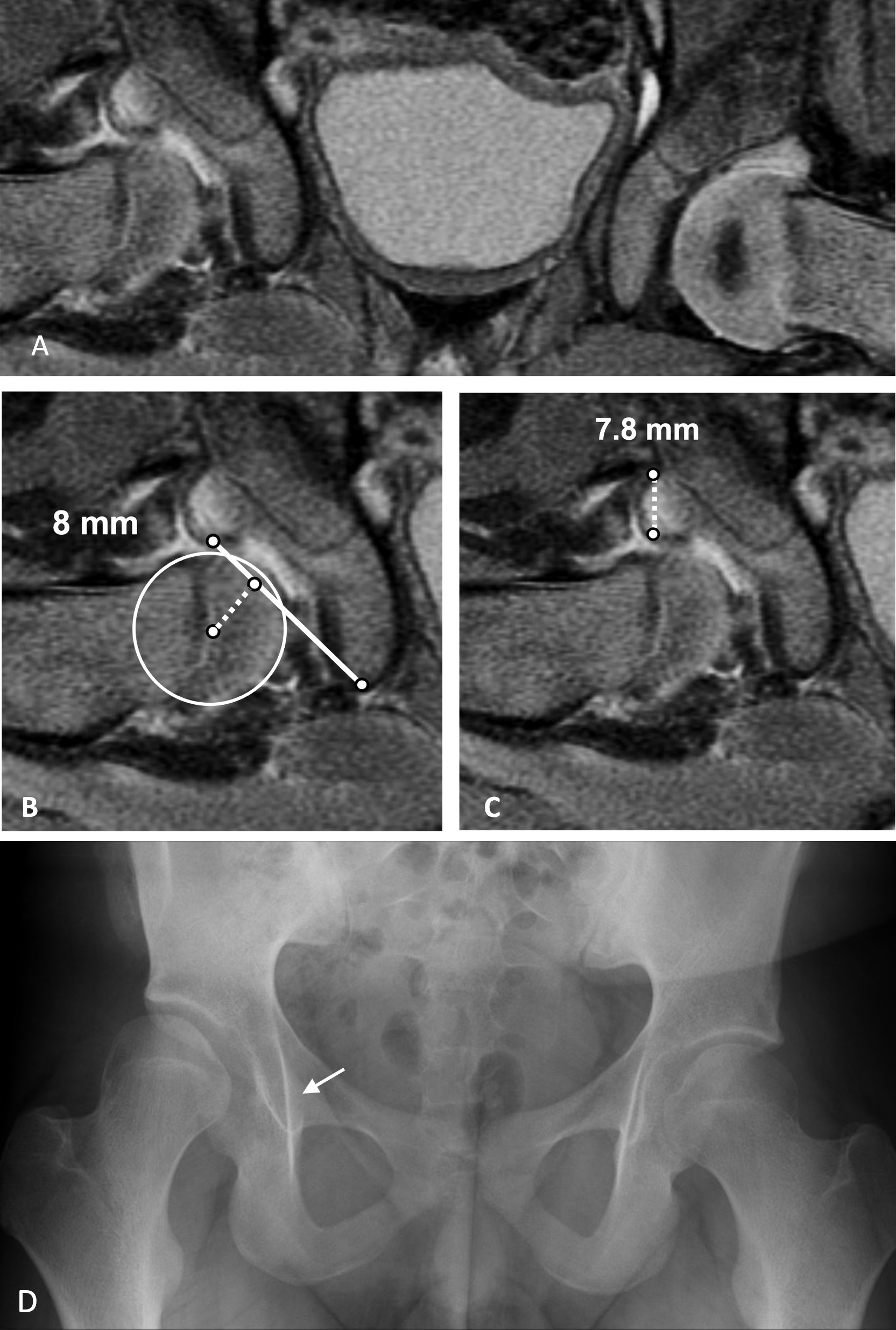 Clinical case of a 9-month-old female patient treated with closed reduction of the right hip, with MRI values above the established thresholds and with residual hip dysplasia 15 years after reduction. (MRI scans: post-contrast coronal, proton density-weighted, fast spin-echo images with fat-saturation.)