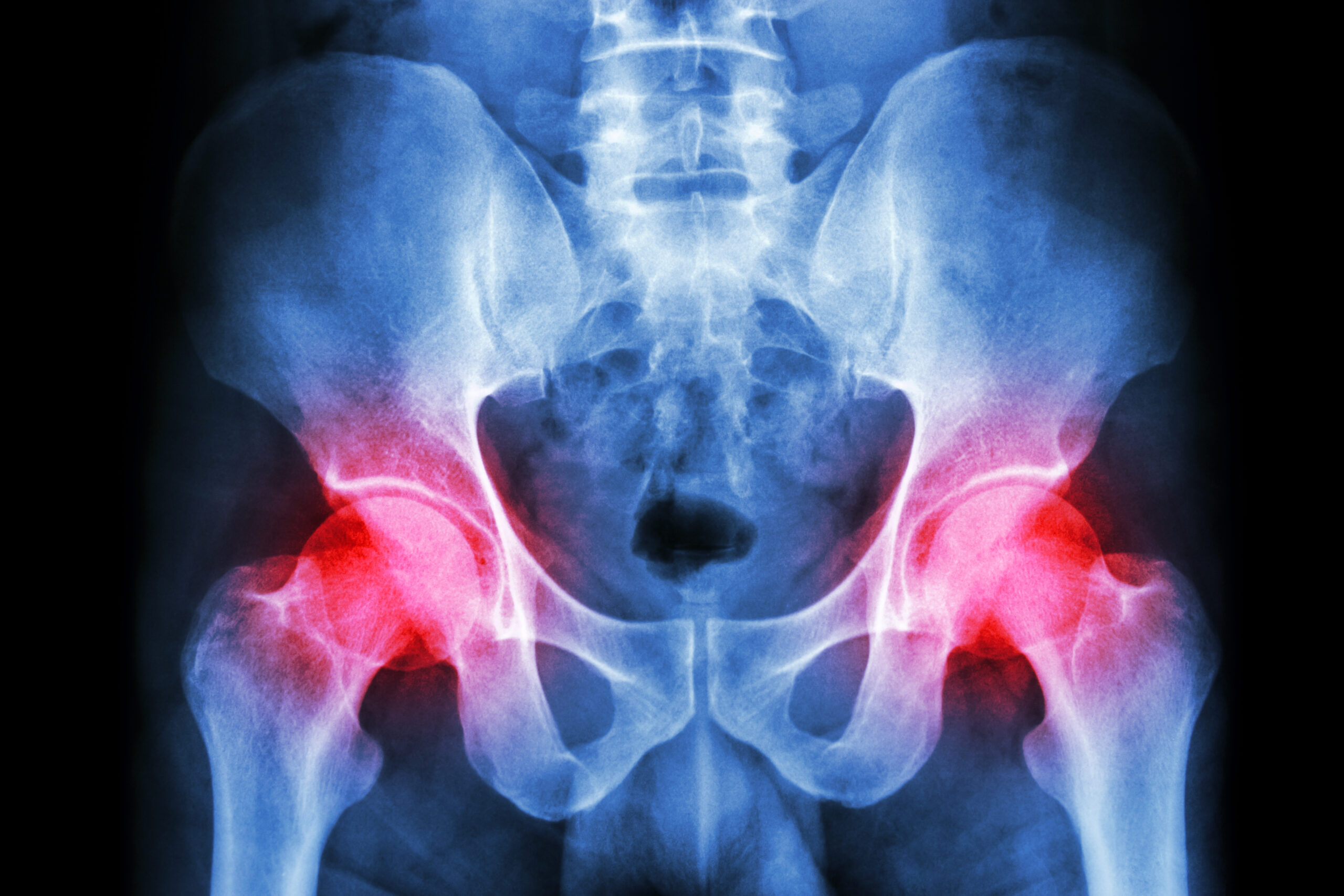 Hip radiograph with joints highlighted in red.