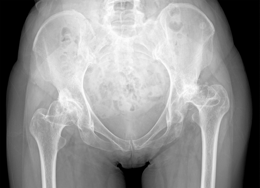 Radiograph demonstrating a once-typical case of hip osteoarthritis (OA) in Japan. We diagnosed both hips as having secondary OA due to hip dysplasia; the left hip showed Crowe type-II subluxation.