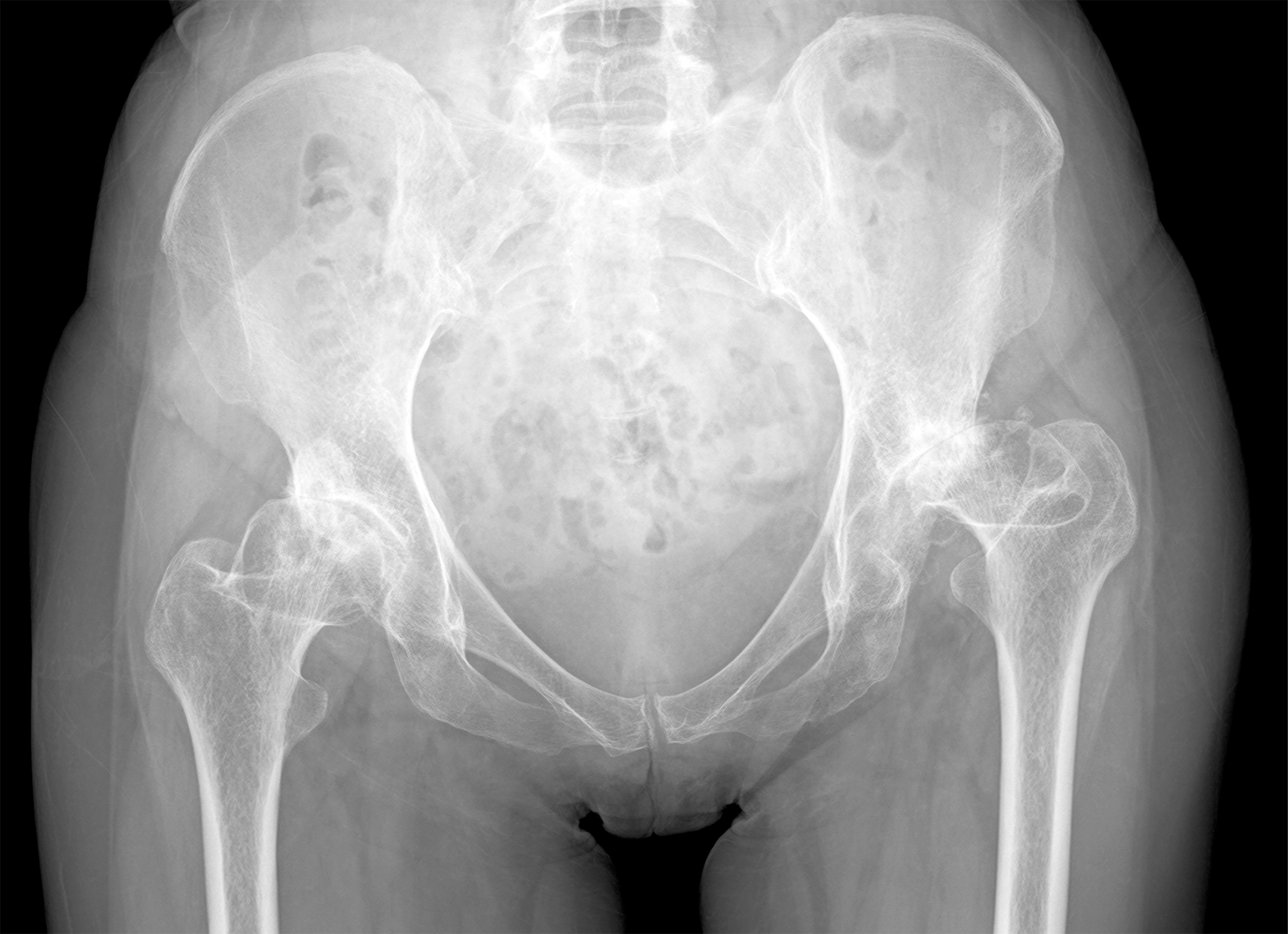 Radiograph demonstrating a once-typical case of hip osteoarthritis (OA) in Japan. We diagnosed both hips as having secondary OA due to hip dysplasia; the left hip showed Crowe type-II subluxation.