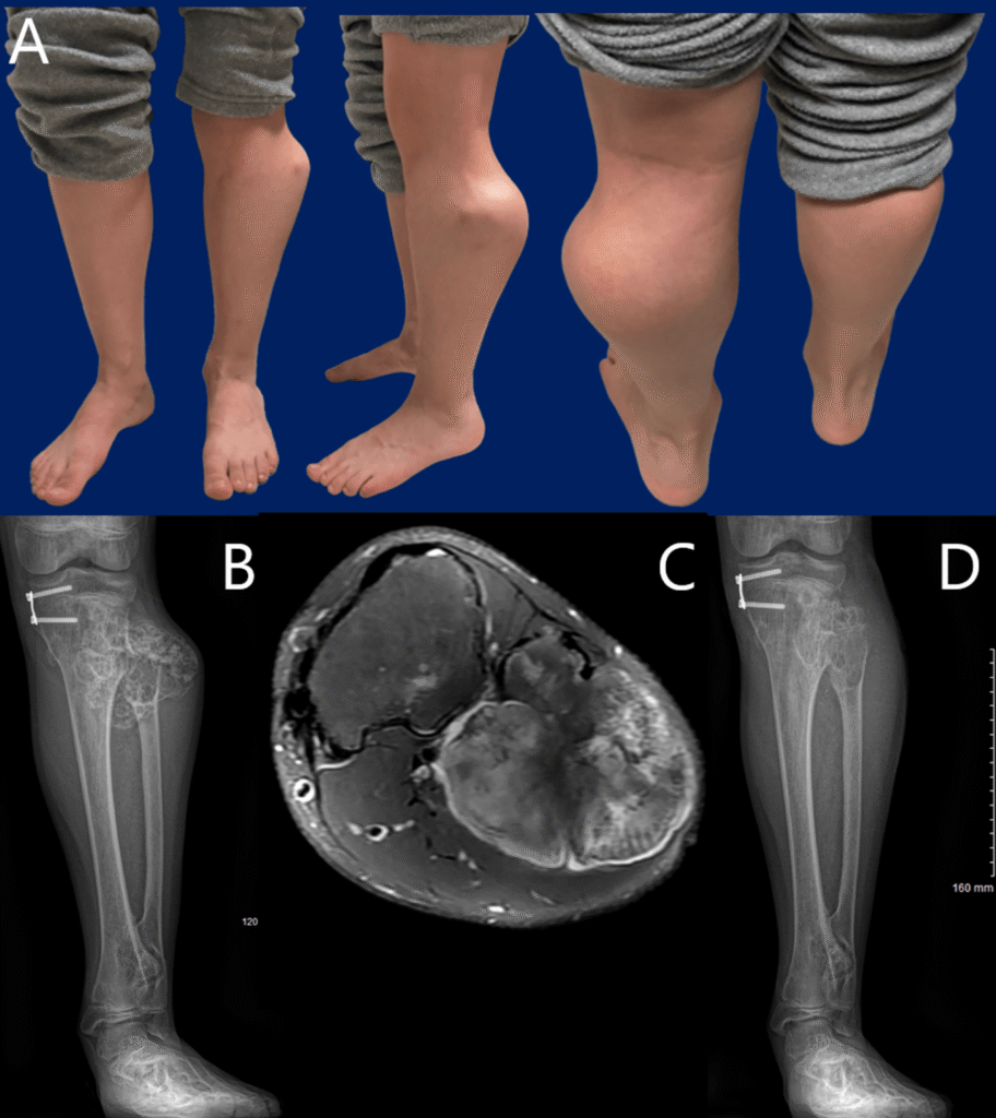 Peroneal Nerve Decompression in Multiple Hereditary Exostoses